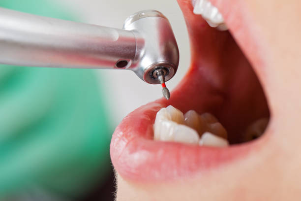 Best Emergency Tooth Extraction in Decorah, IA